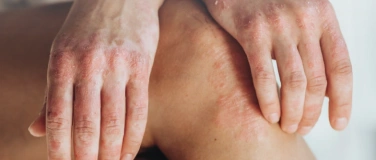 Event-Image for 'Life-Visite - Psoriasis-Komorbitäten'